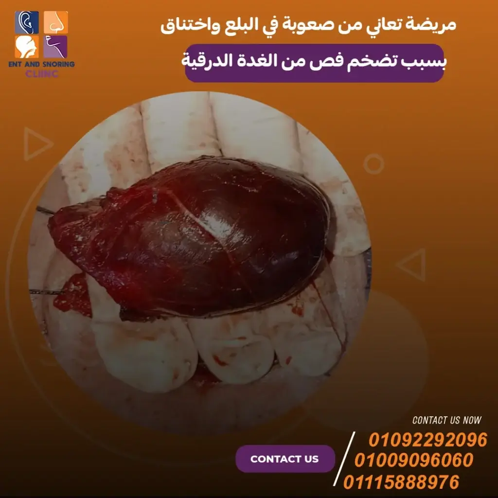 سبب تضخم فص الغدة الدرقية