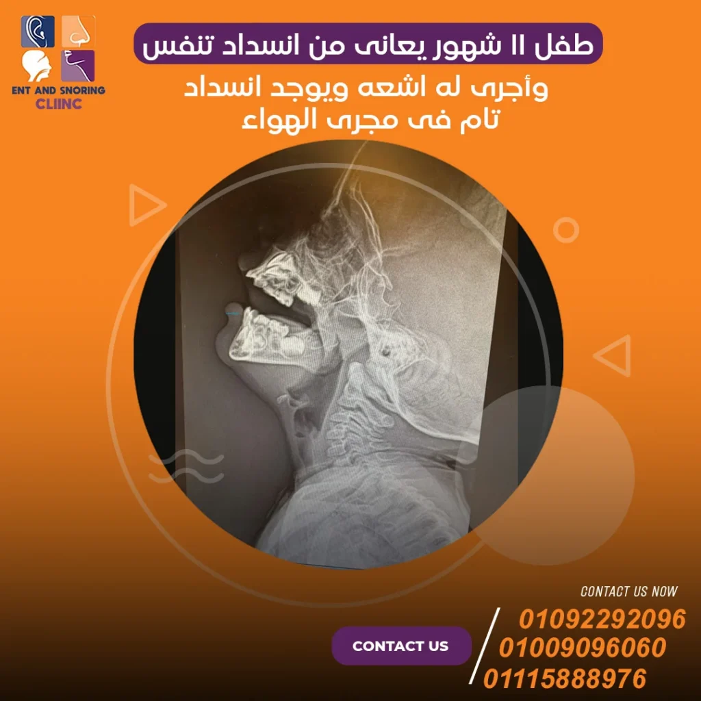 طفل ١١ شهور يعاني من انسداد تنفس