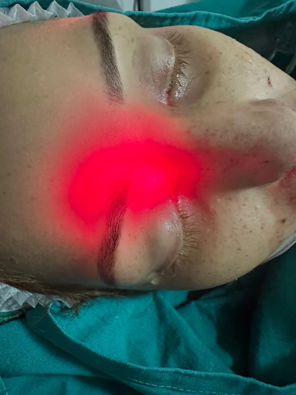 مريض يعانى من انسداد تنفس بسبب لحميات جيوب انفيه