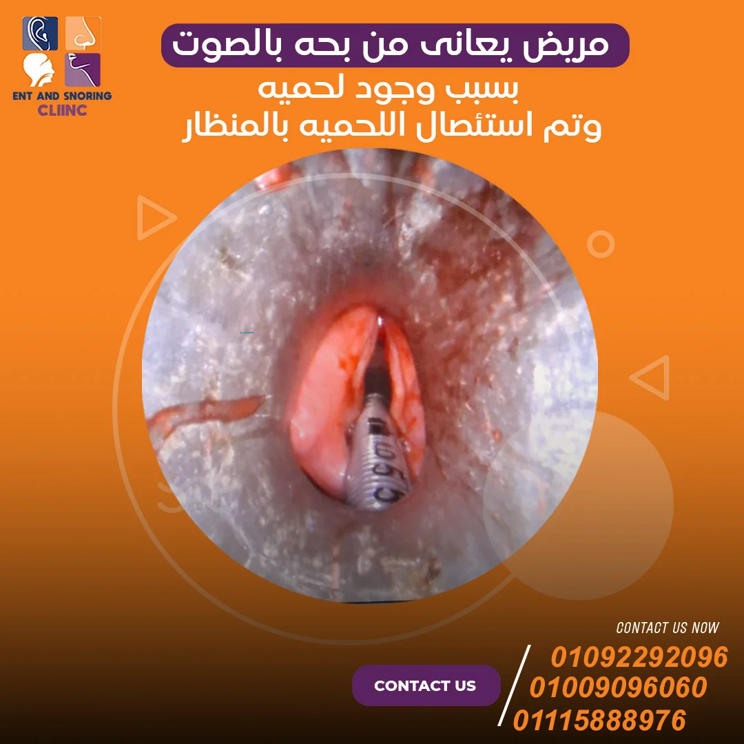 مريض يعاني من بحة بالصوت بسبب وجود لحمية وتم استئصال اللحمية بالمنظار