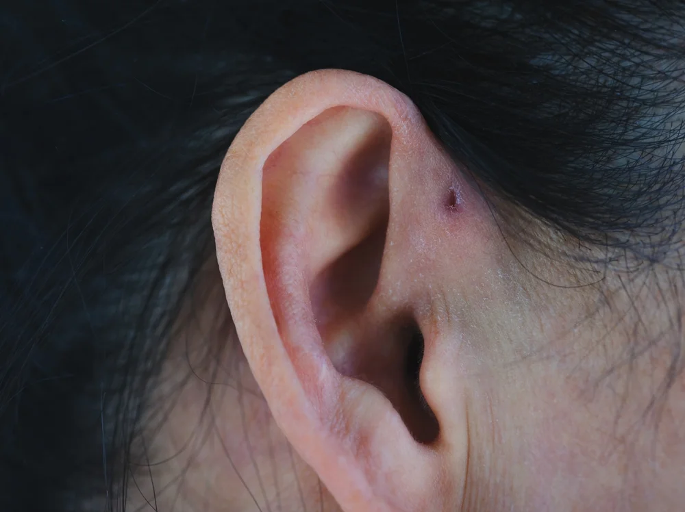 ناسور صوان الأذن امتي لازم نعملة؟