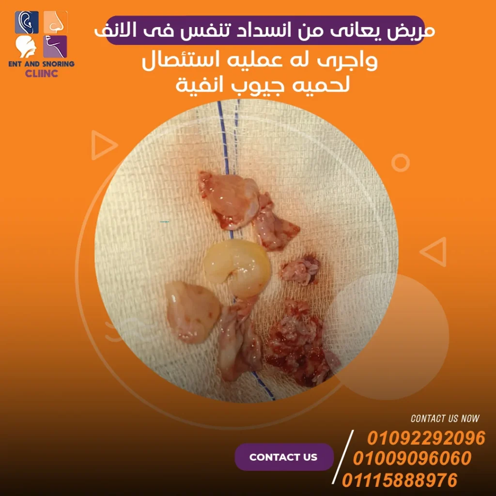 مريض يعانى من انسداد تنفس فى الأنف وأجرى له عملية استئصال لحمية جيوب انفية