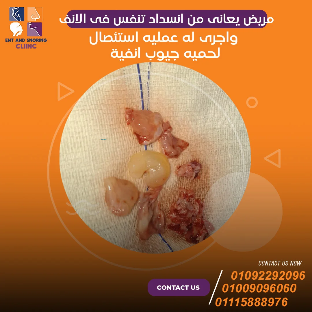 مريض يعانى من انسداد تنفس فى الأنف وأجرى له عملية استئصال لحمية جيوب انفية