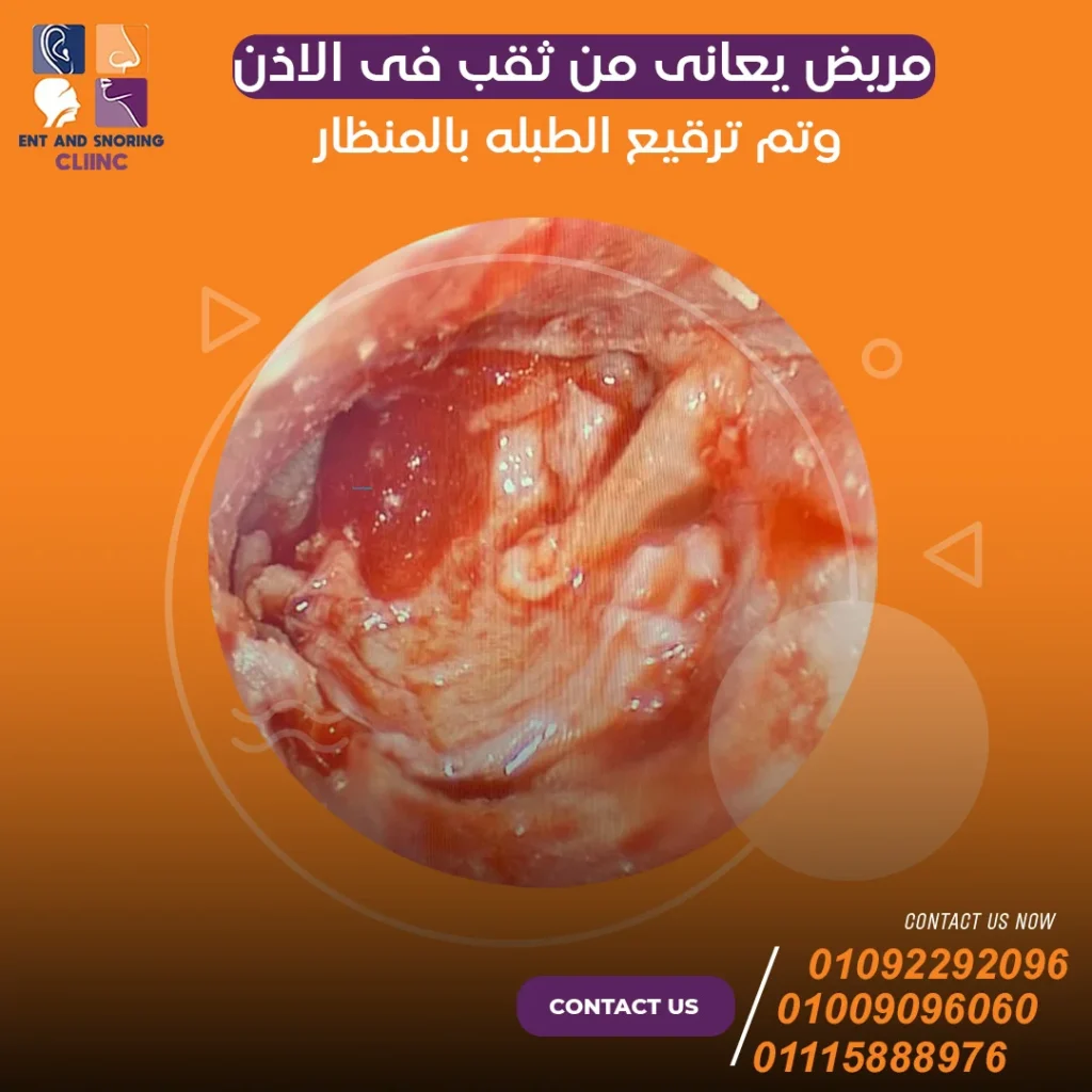 مريض يعاني من ثقب فى الاذن وتم ترقيع الطبله بالمنظار