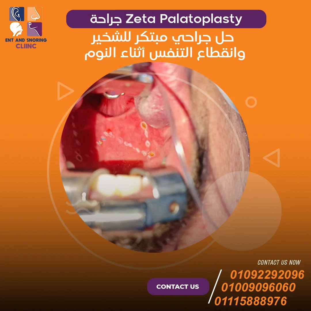 جراحة Zeta Palatoplasty حل جراحي مبتكر الشخير وانقطاع التنفس أثناء النوم
