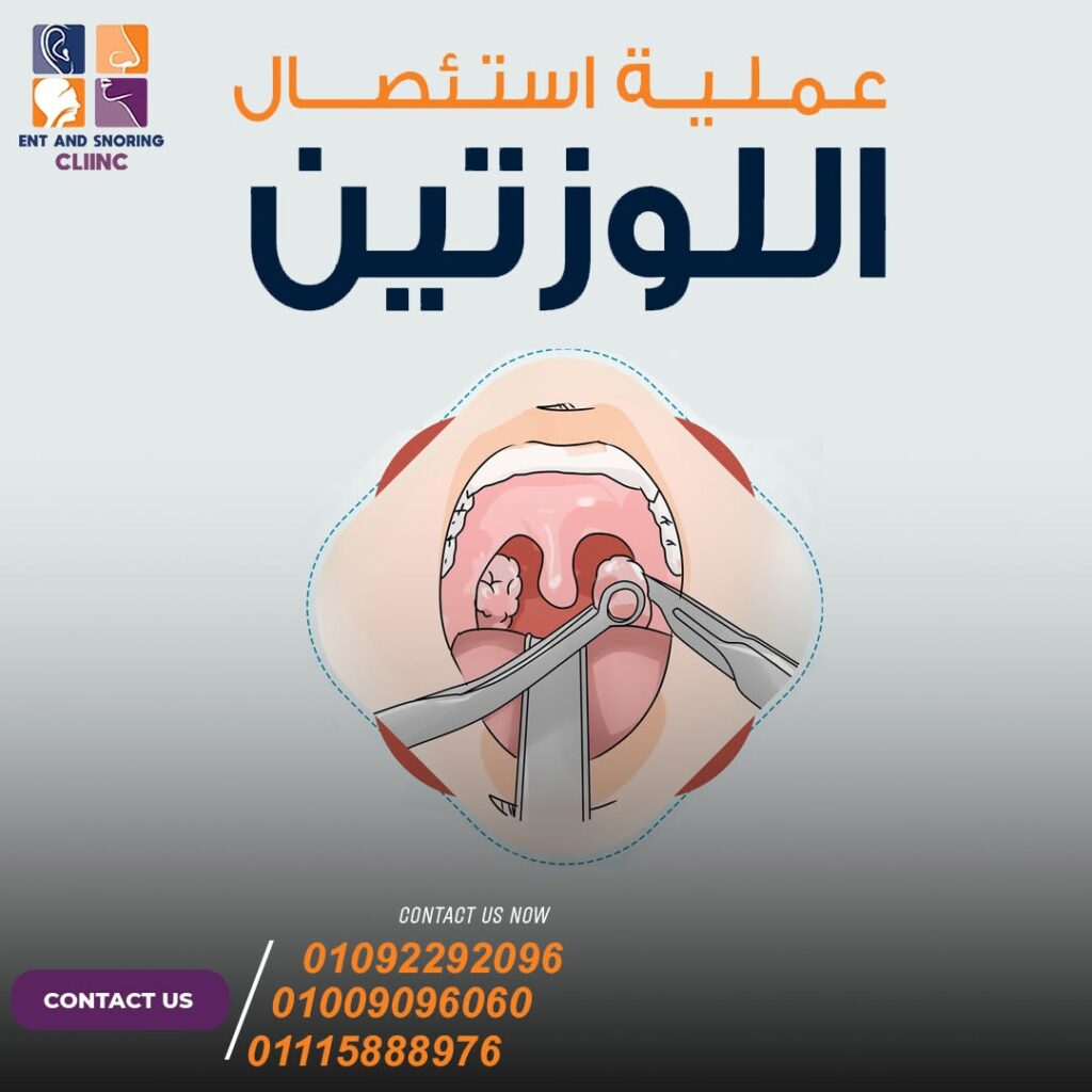ما هي التعليمات الواجب اتخاذها بعد استئصال عملية اللوزتين؟ 