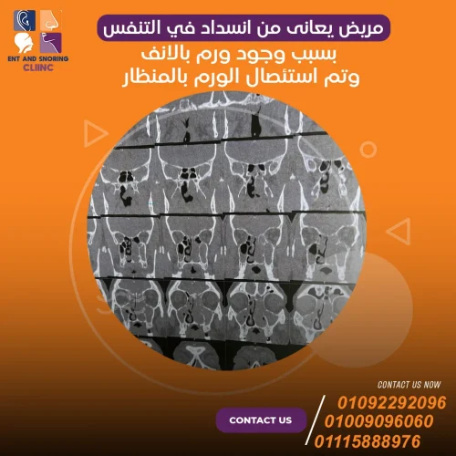 مريض يعانى من انسداد في التنفس بسبب وجود ورم الأنف وتم استئصال الورم بالمنظار